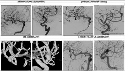 Safety and Long-Term Efficacy Outcomes for Endovascular Treatment of Wide-Neck Bifurcation Aneurysms of the Middle Cerebral Artery: Insights From the SMART Registry